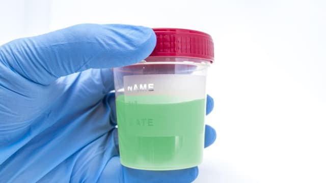 Vì sao nước tiểu màu xanh lá cây?