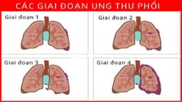 Phác đồ điều trị ung thư phổi giai đoạn 3 chưa di căn