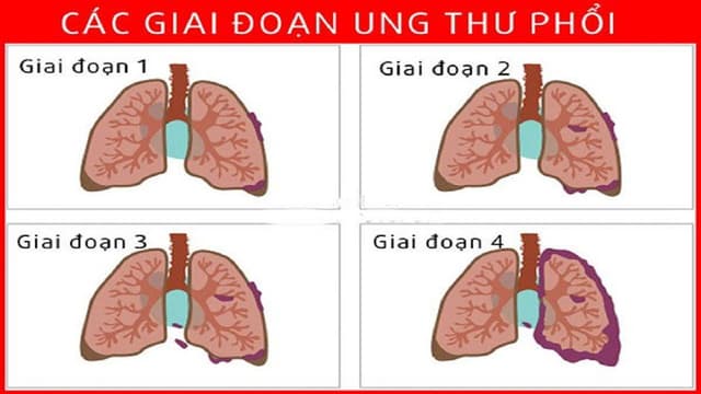 Phác đồ điều trị ung thư phổi giai đoạn 3 chưa di căn