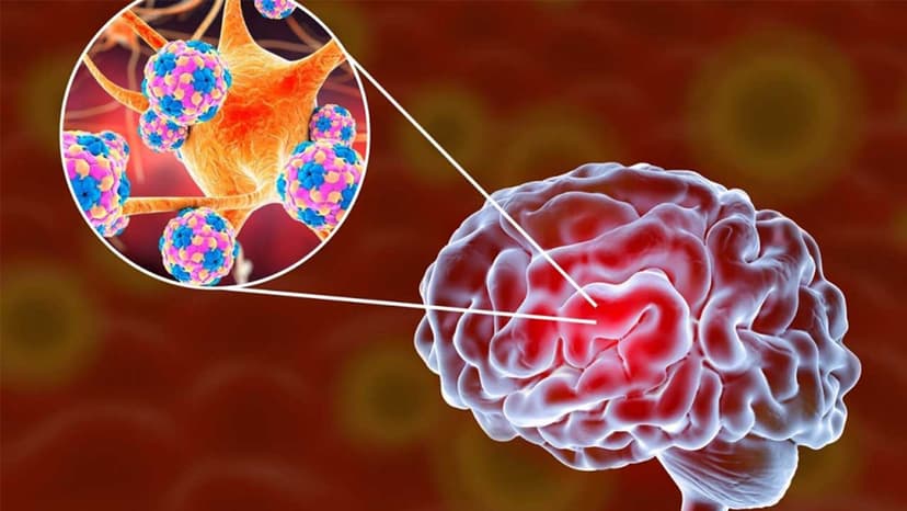 Phân biệt viêm màng não mô cầu AC và BC