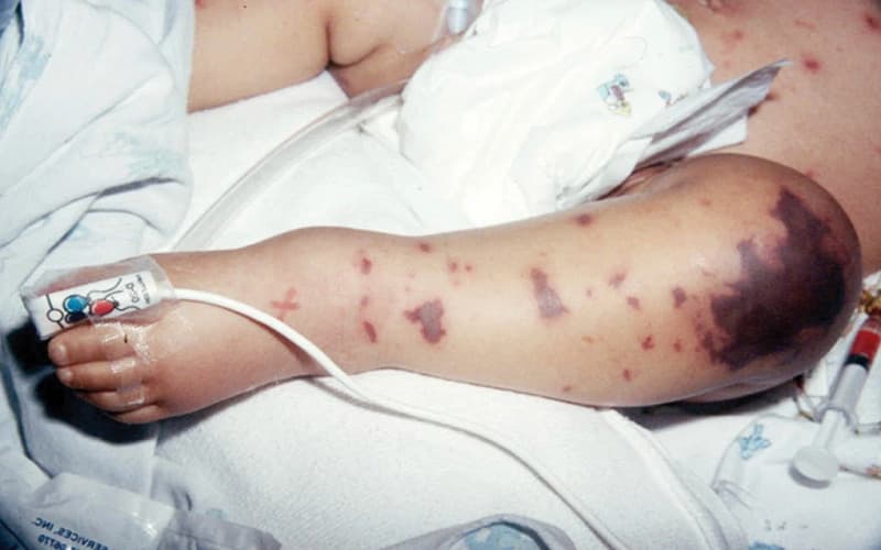 phát ban nhiễm trùng máu