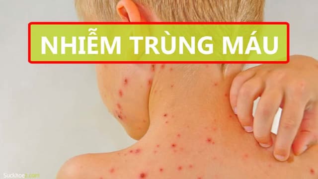 Hiện tượng phát ban nhiễm trùng máu