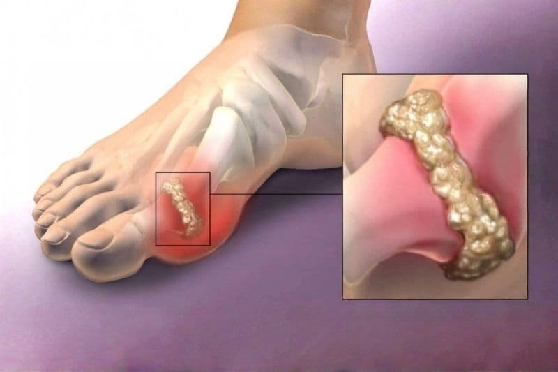 xét nghiệm axit uric có phải nhịn ăn không