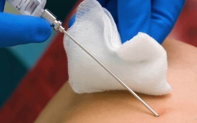 dẫn lưu áp xe gan