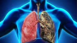 Các phương pháp điều trị ung thư phổi mới nhất