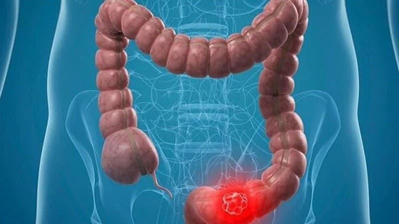 xuất huyết hậu môn là bệnh gì