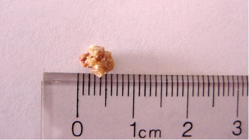 sỏi niệu quản 1/3 giữa