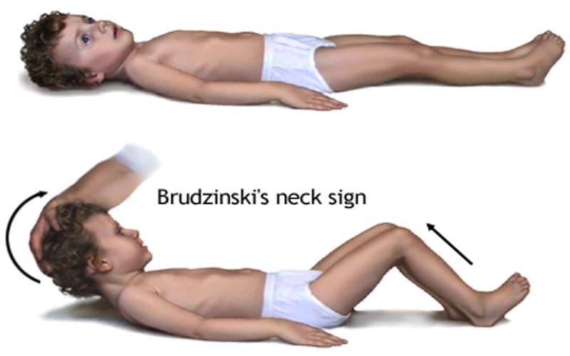 sốt viêm màng não ở trẻ