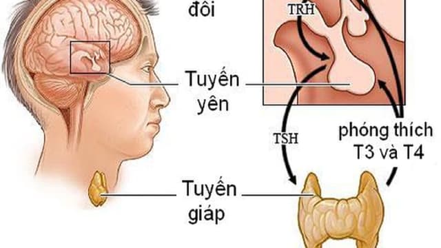 Suy giáp do suy tuyến yên