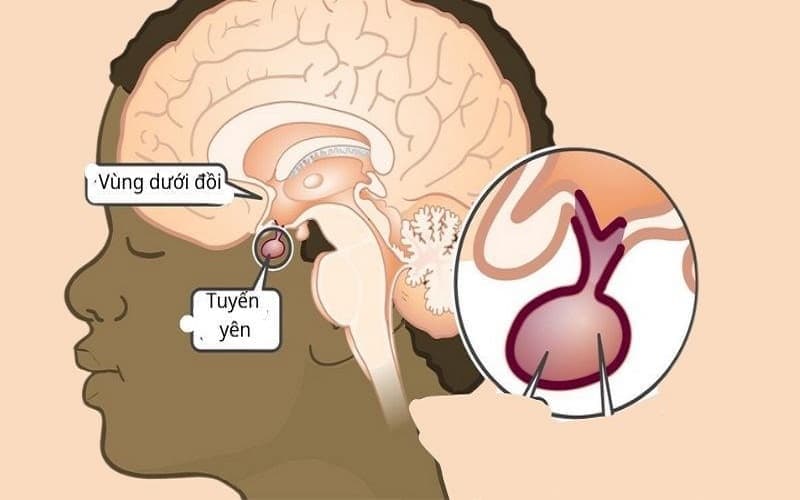 bệnh suy tuyến yên có di truyền không