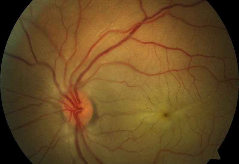 tắc động mạch trung tâm võng mạc