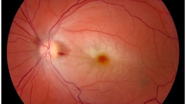 Tắc động mạch trung tâm võng mạc là bệnh gì?