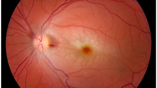 Tắc động mạch trung tâm võng mạc là bệnh gì?