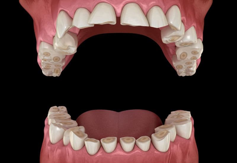 tại sao lại nghiến răng khi ngủ