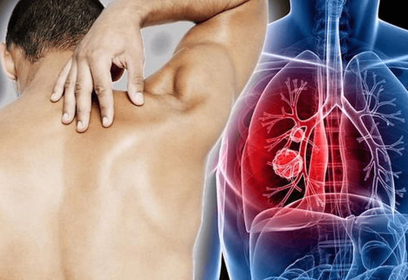 ung thư phổi phát hiện sớm có chữa được không