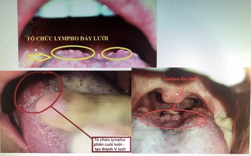 tăng sinh mô lympho đáy lưỡi thành họng có nguy hiểm không