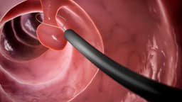 Polyp dạ dày có nguy hiểm không, có tự hết không?