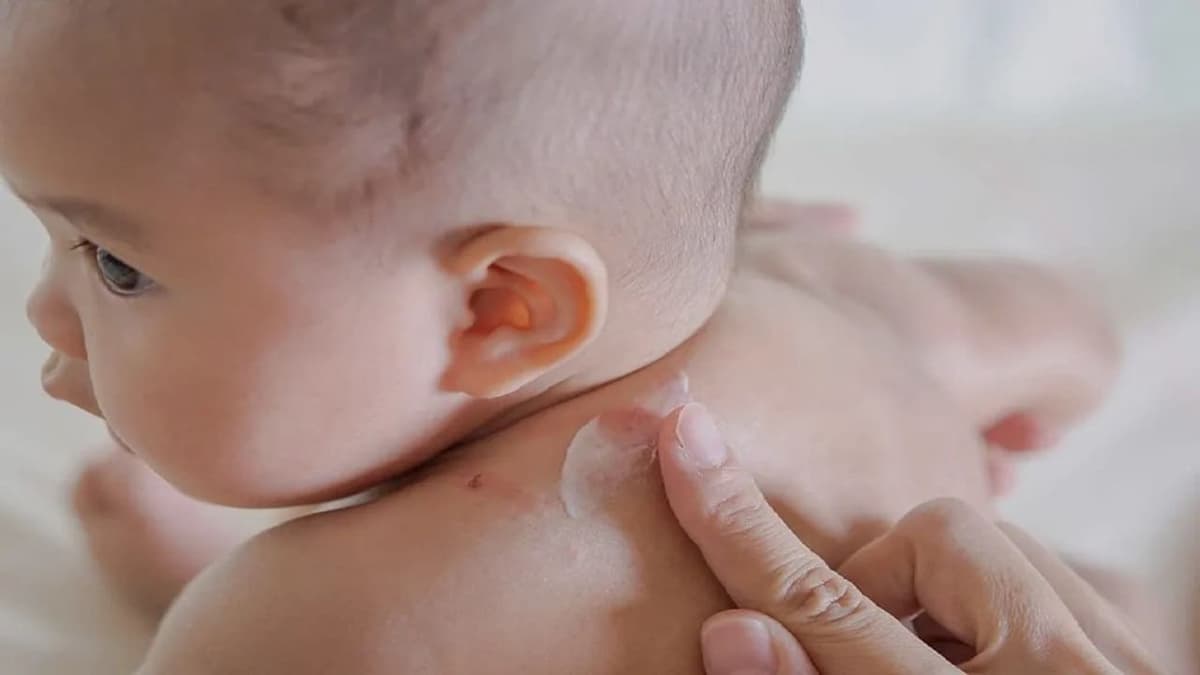 Các thuốc bôi kháng histamin cho trẻ em