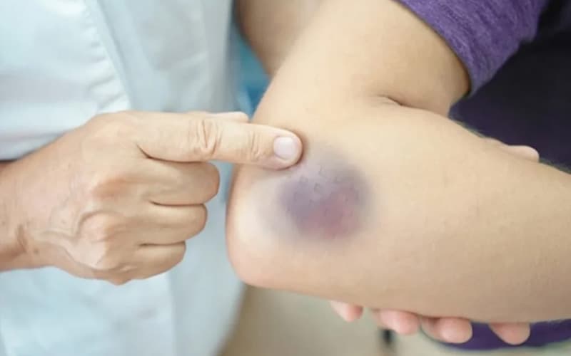 thuốc chống đông clopidogrel