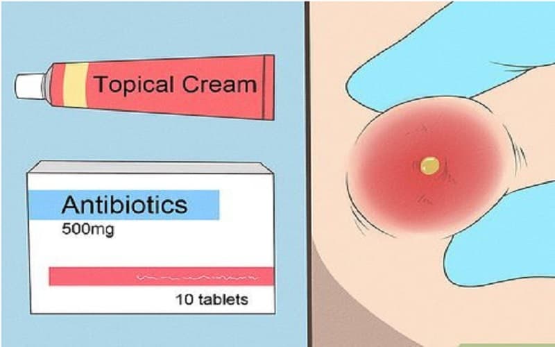 thuốc kháng sinh điều trị mụn nhọt ở mông