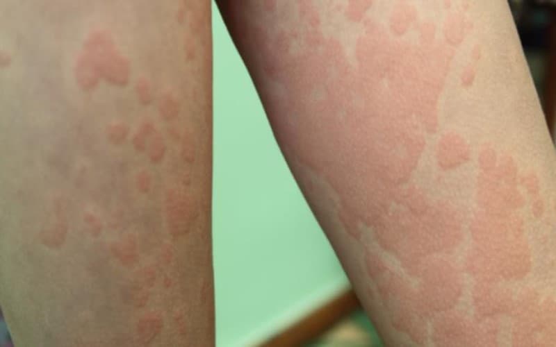 liều dùng amoxicillin 500mg cho người lớn