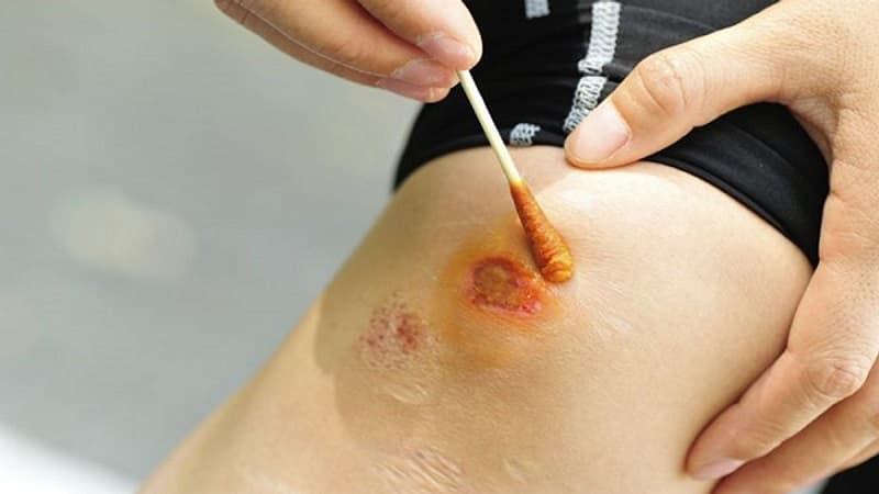 bôi thuốc kháng sinh vào vết thương hở