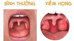 Các thuốc kháng sinh cho trẻ em bị viêm họng
