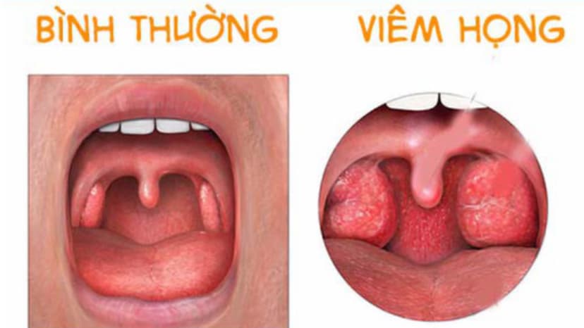Các thuốc kháng sinh cho trẻ em bị viêm họng