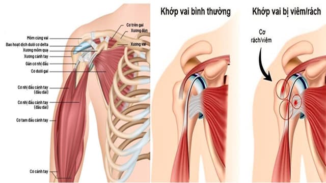 Có thể dùng thuốc kháng sinh chữa viêm gân vai không?