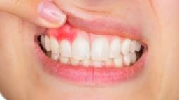 Các thuốc kháng sinh điều trị viêm chân răng