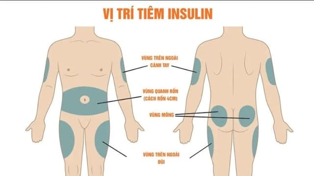 Tiêm thuốc tiểu đường ở vị trí nào để hiệu quả nhất
