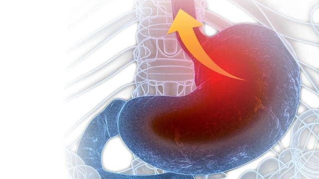 Nguyên nhân trào ngược dạ dày gây ho kéo dài về đêm