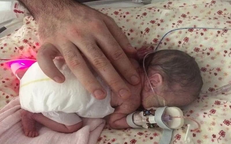 trẻ sinh non 1 tháng tăng bao nhiêu kg