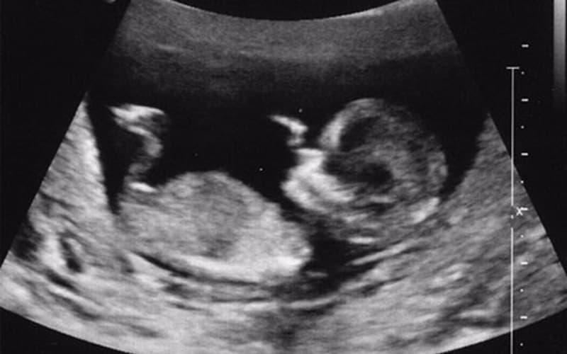 u máu ở trẻ sơ sinh nguyên nhân