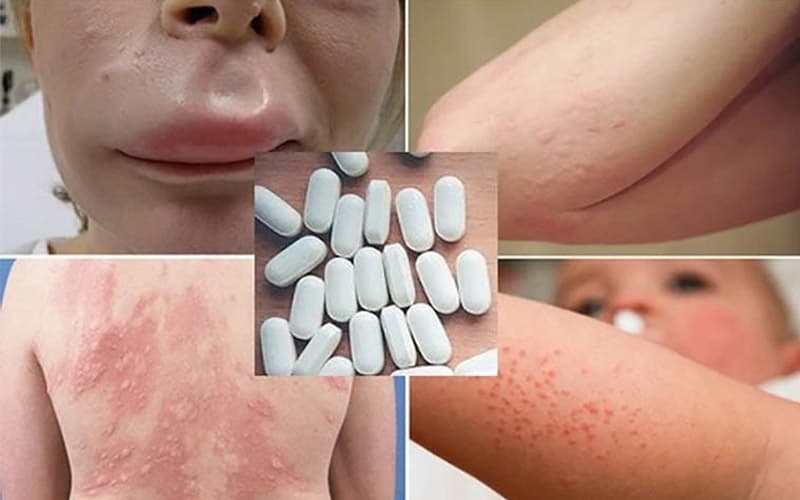 dị ứng amoxicillin