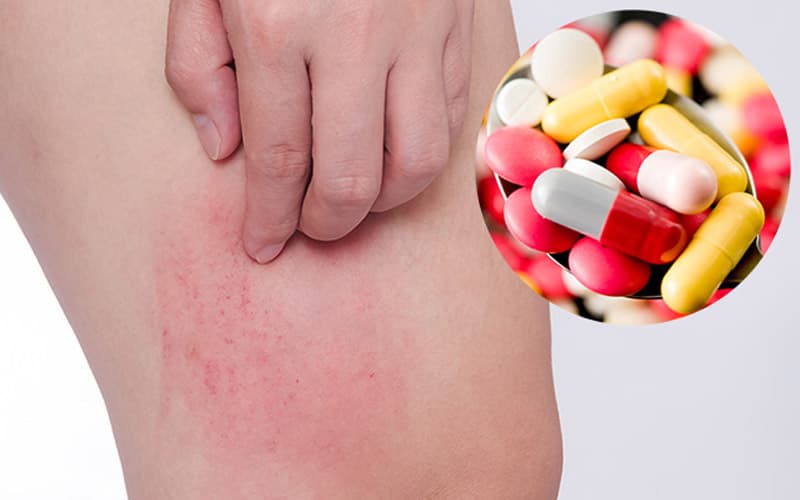 dị ứng amoxicillin