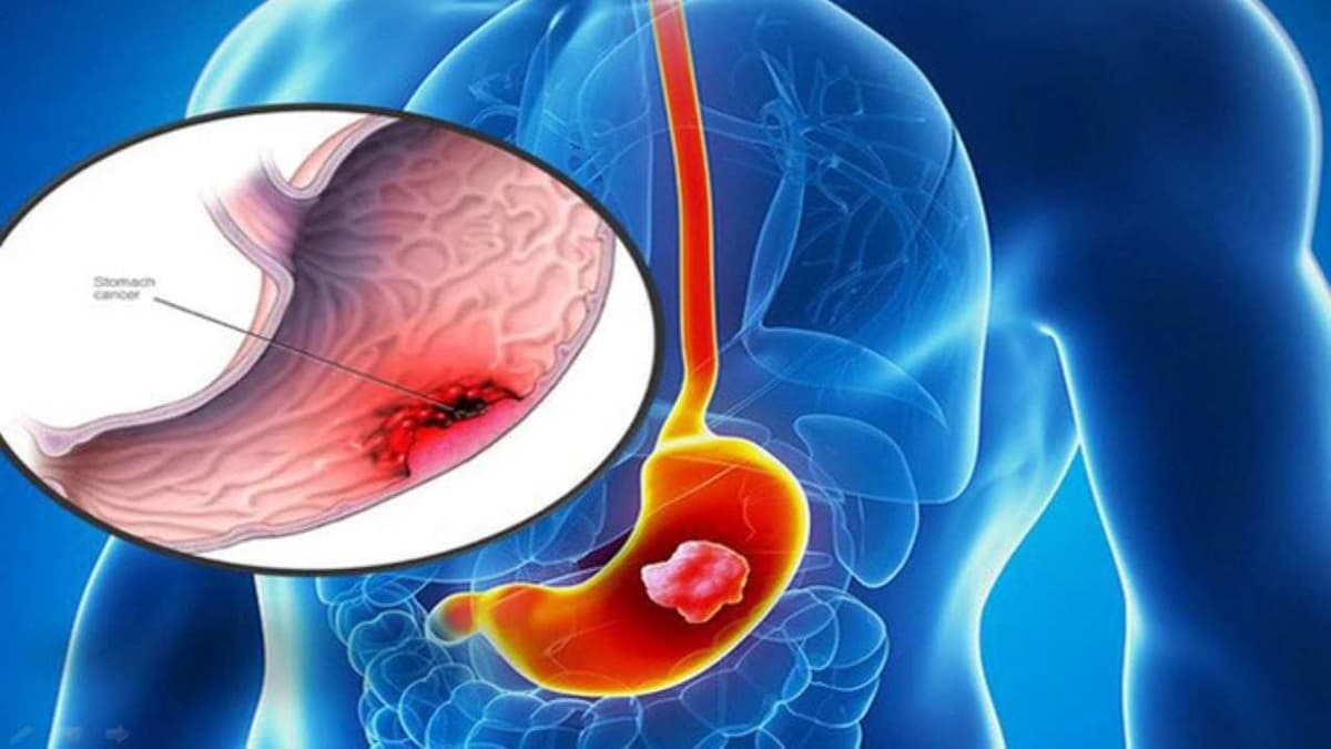 Các triệu chứng sau khi nội soi dạ dày dễ gặp