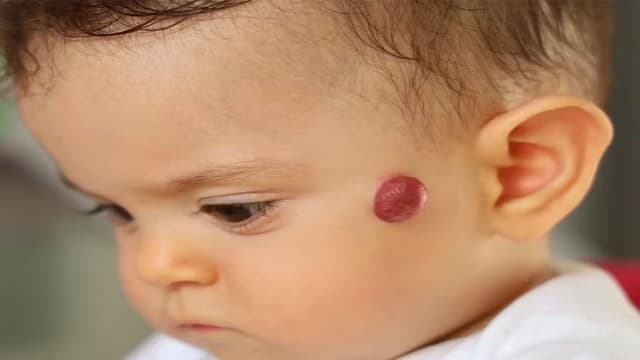 U máu ở trẻ sơ sinh có tự hết không?