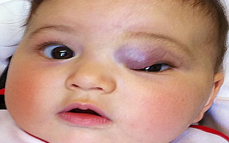 u máu ở trẻ sơ sinh nguyên nhân