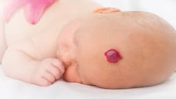 U máu ở trẻ sơ sinh Nguyên nhân, có nguy hiểm không