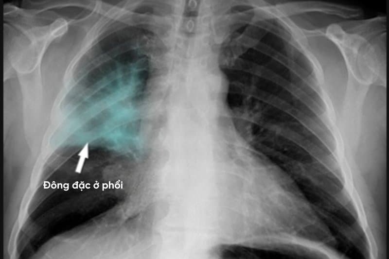 chụp x quang có phát hiện ung thư phổi không