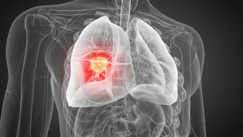 ung thư phổi giai đoạn 2 có nguy hiểm không