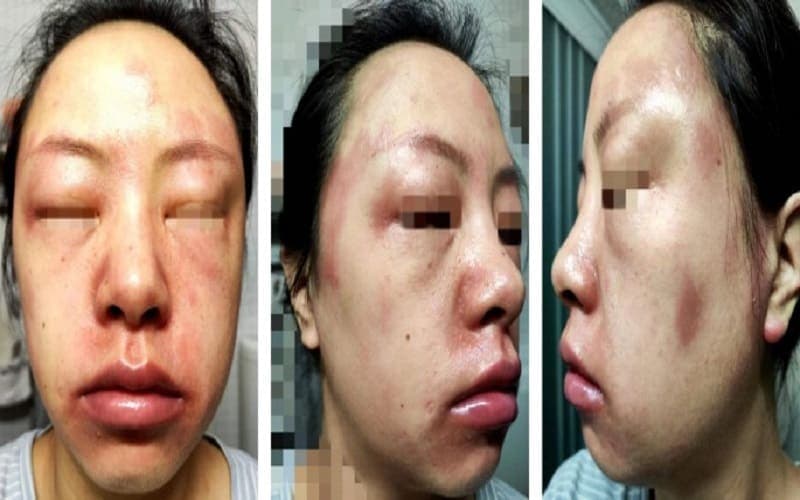 uống thuốc kháng sinh bị phù mặt