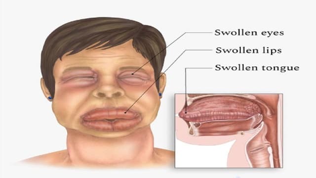 Vì sao uống thuốc kháng sinh bị phù mặt?