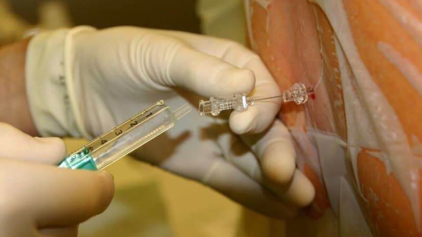 Vị trí chọc dịch ổ bụng để tháo dịch tràn dưới hướng dẫn siêu âm