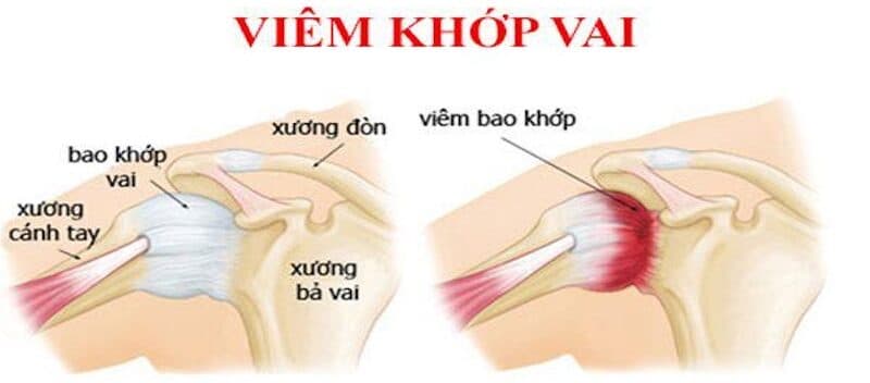 thuốc kháng sinh chữa viêm gân vai