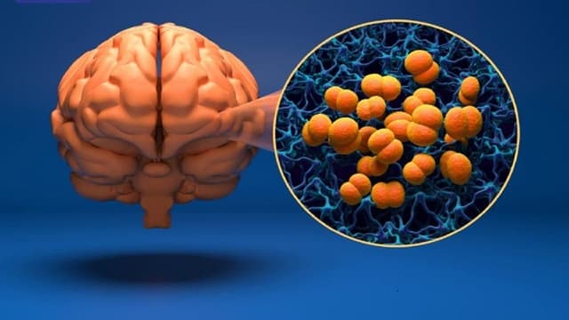 Bệnh viêm màng não có khỏi hẳn không?