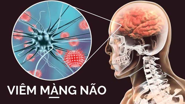 Viêm màng não có nguy hiểm không