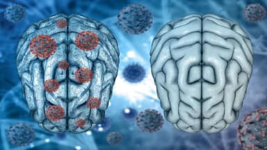 Viêm màng não điều trị bao lâu thì khỏi?