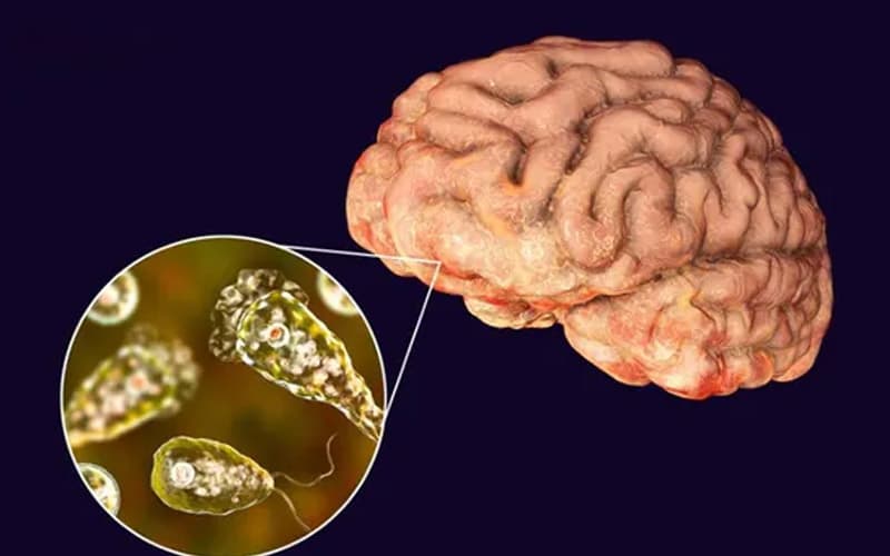 viêm màng não tăng bạch cầu ái toan